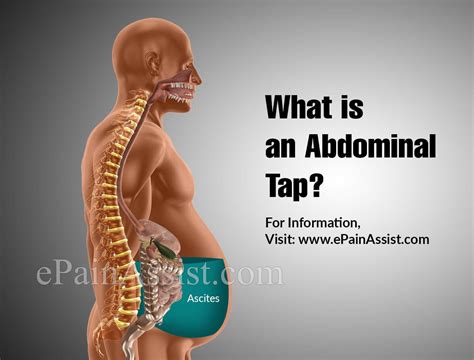 (Video: Heinsohn et al. . Hollow sound when tapping right abdomen